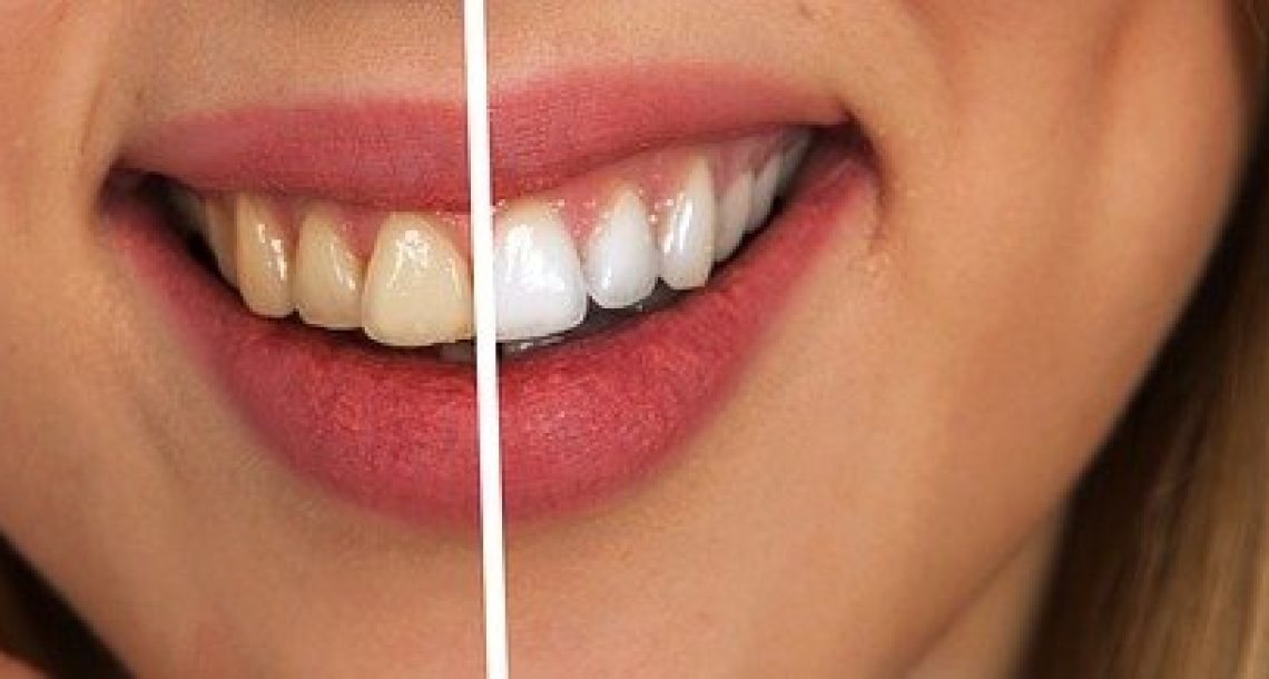איך אפשר להפוך את השיניים ללבנות יותר?